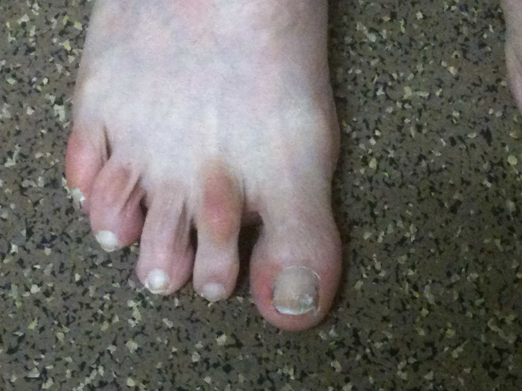 Hammer Toe Clinical Photo